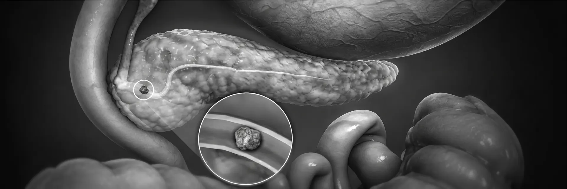 Illustration of the pancreas with an inset detail of pancreatic tissue
